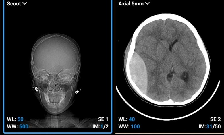 What caused sean's brain injury impact texas